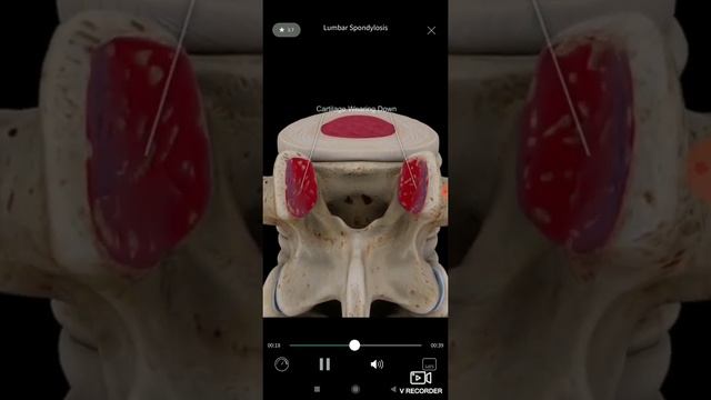 Спондилез поясничного отдела позвоночника. 3D анатомия.