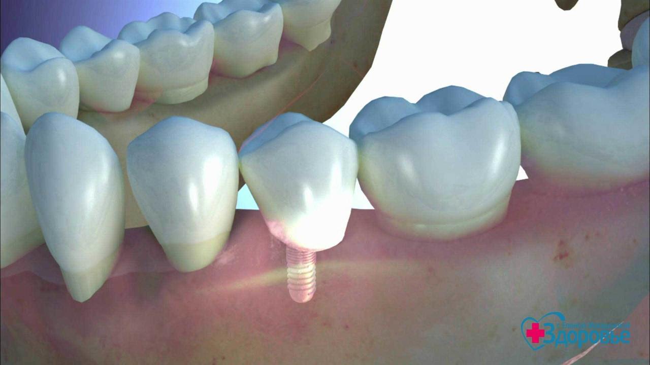Чистка зубов улан удэ. Зубной имплантат. Импланты зубные нового поколения. Доступная имплантация зубов.