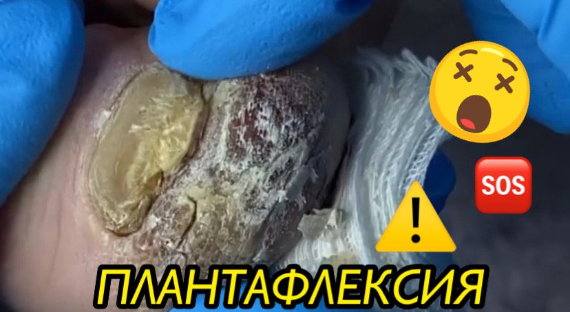 Плантафлексия ?⚠️❗️??