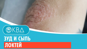 ? Зуд и сыпь локтей. Клинический случай №919