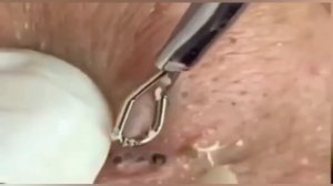 Самое залипательное видео давить прыщи Черные точки