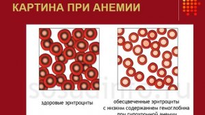 2 курс ФКП. Лекция на тему "Анемии и лейкозы"