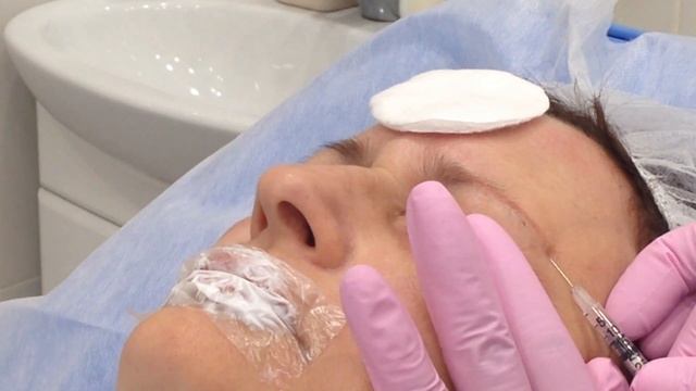 Меди Лайт; Мезоботокс. Устранение морщин. Область вокруг глаз смотреть онлайн