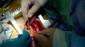 Имплантация аортального клапана