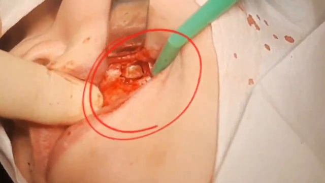 Удаление постоянного зуба из гайморовой пазухи