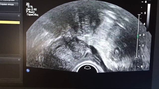 очередной полип эндометрия. another endometrial polyp.