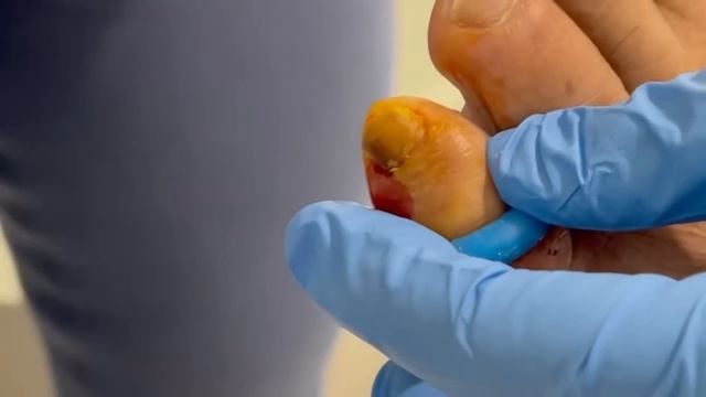 Melanoma UNDER the toenail?!