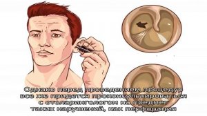 Как избавиться от пробки в ухе