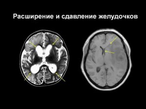 Поражения головного мозга на МРТ