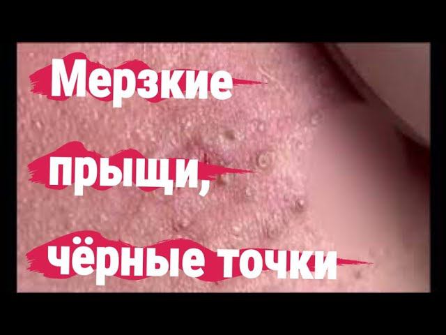 выдавливание прыщей №26