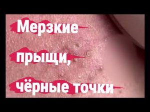 выдавливание прыщей №26