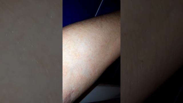 1 Псориаз сдался за 10 дней !!!  Делюсь впечатлениями смотреть онлайн