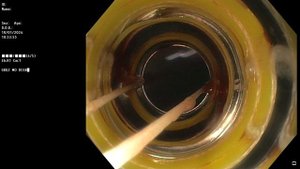 Лигирование варикозно расширенных вен пищевода.