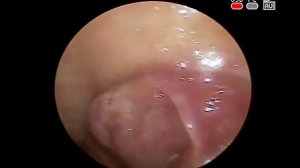 #ЛИМФОМА #ОПУХОЛЬ #ГЛОТКИ ДИАГНОСТИКА КЛИНИКА ОБРАЗЦОВА