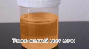 Не игнорируйте цвет мочи.Врачи предупреждают.