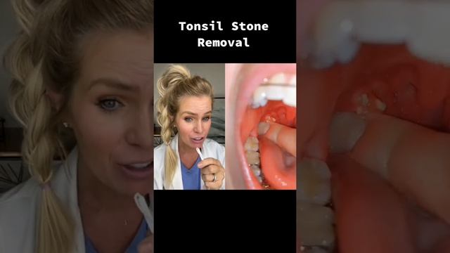 Big juicy tonsil stone removal! #tonsilstones #dentist #tonsils