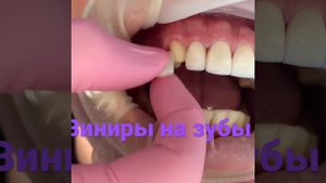 Виниры на зубы поставить