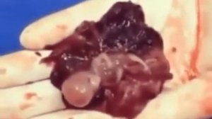 Выкидыш Плод 12 недель