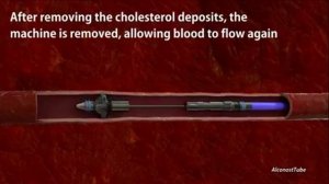 Чистка сосудов