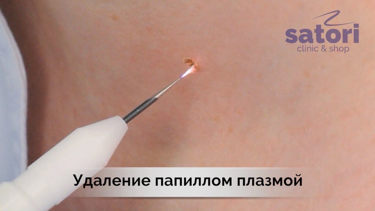 Удаление папиллом и других новообразований кожи плазмой
