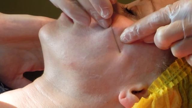 Для упругости кожи лица. Армирование филлером Скульптра