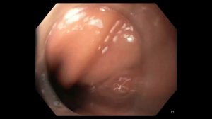 Cancer Resection 1 out of 5