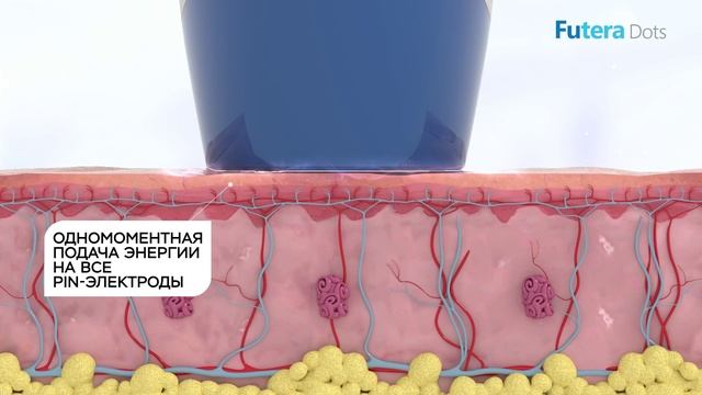Futera Dots – фракционный плоскостной RF для работы с лицом и телом