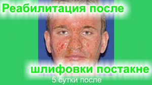 Реабилитация после лазерной шлифовки постакне