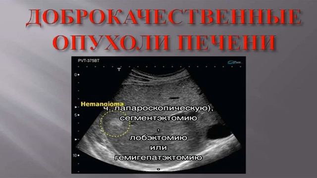 Как выглядит рак печени