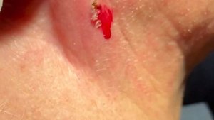 Удаление кожного рога