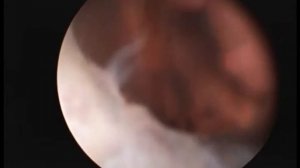 Эндометриоидная киста шейки матки  Ovula Nabothian