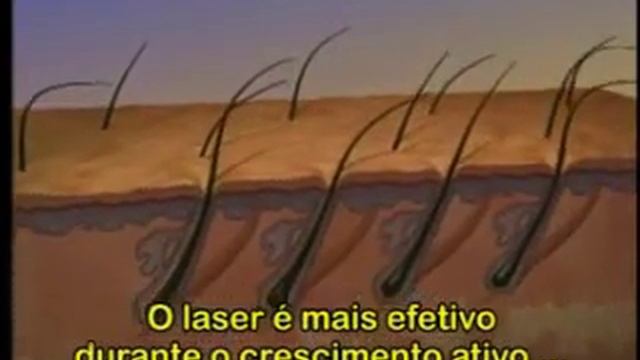 Реклама диодного лазерна Light Sheer смотреть онлайн