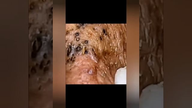 НОВОЕ ВИДЕО 2022  Прыщи давить залипательные