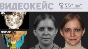 Удаление опухоли (амелобластомы) нижней челюсти