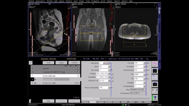 Anal fistula (perianal fistula) MRI scan protocols, positioning and planning