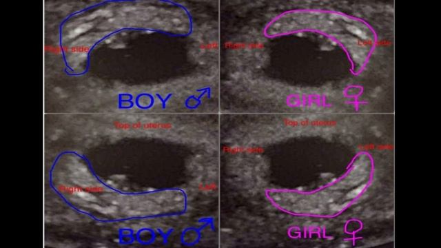 Baby gender prediction in tamil | gender prediction using scan report | смотреть онлайн