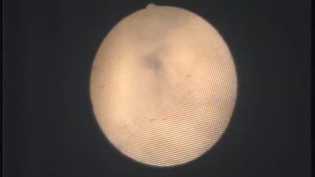 Спайки в цервикальном канале. Разъединение небольно. смотреть онлайн