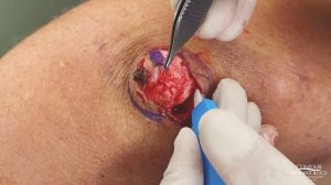 A SURPRISE Inside This Big Blackhead | CONTOUR DERMATOLOGY