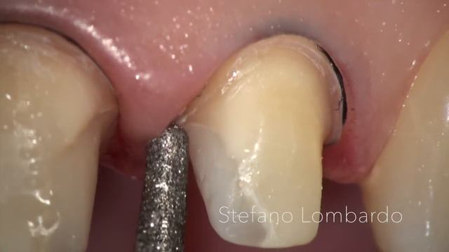 Chamfer vs BOPT: Lithium Disilicate adhesive crowns, by Stefano Lombardo смотреть онлайн