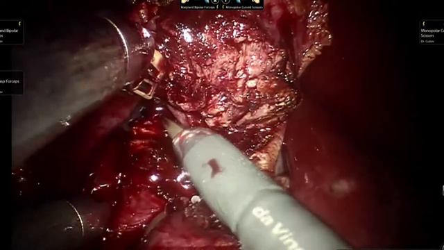 Робот-ассистированная резекция почки. Оператор: Гулиев Б.Г. EndoUroCenter. смотреть онлайн