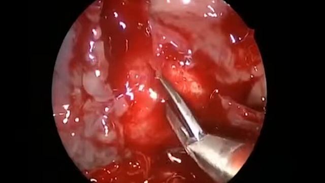 Удаление аденомы гипофиза эндоскопически 1 смотреть онлайн