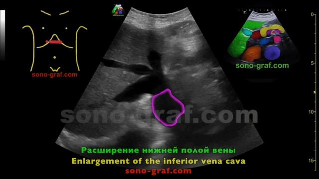 УЗИ - Расширение печеночных вен смотреть онлайн