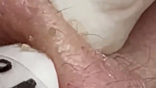 Прыщики. прыщи. акне. чистка. реконструкция смотреть онлайн