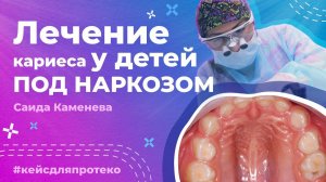 Лечение молочных зубов под наркозом