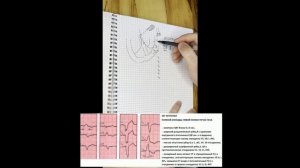 ЭКГ. Блокады ножек пучка Гиса