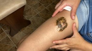 Лучшее средство ОТ СИНЯКОВ И ГЕМАТОМ! Как быстро убрать (избавиться) синяк в домашних условиях