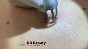 Удаление родинок лазером CO2 в Израиле Dr Beauty