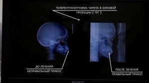 Дистальный прикус