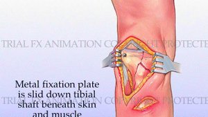 Tibial Plateau Fracture with Metal Plate Fixation