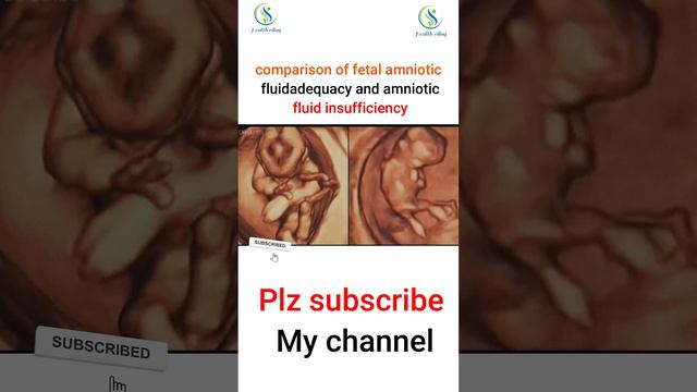 comparison of fetal amniotic fluid adequacy and amniotic fluid insufficiency #ultrasound #fetus